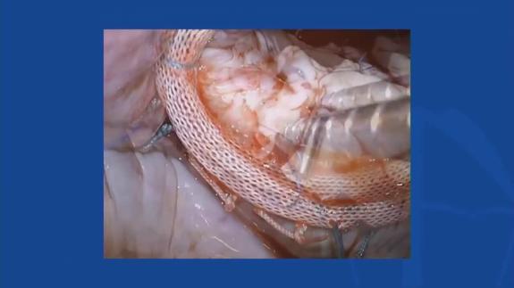 Screen capture of the video Ahmed El-Eshmawi - Residual Mitral Regurgitation – Decision Making and Management