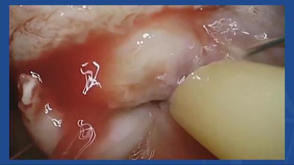 Screen capture of the video Aarti Patil - Mitral Valve Repair in Native Mitral Valve Endocarditis