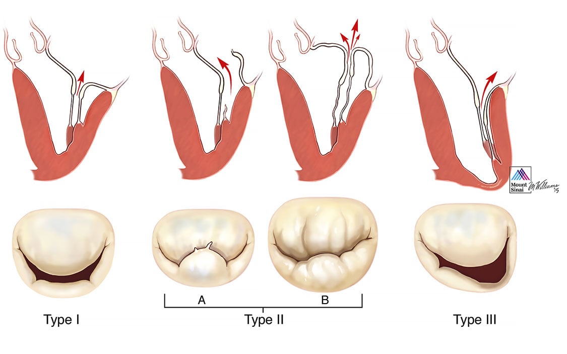 Types of Mitral Valve Disease