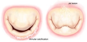 Valves are examined for lesions and calcification