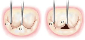 Segmental Valve Analysis